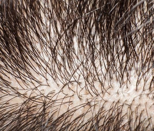 Clinical micro-examination of human scalp and hair follicles under polarized light